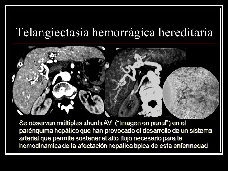 hemangioma hepatico es hereditario